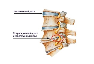 Симптомдары-мойын остеохондроза